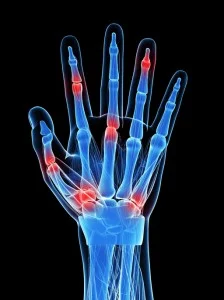 Hand Pain Treatment, hand pain, pain in the hand, houston hand pain, pain in the hand houston