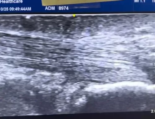 Achilles Heel Pain from Bone Growth