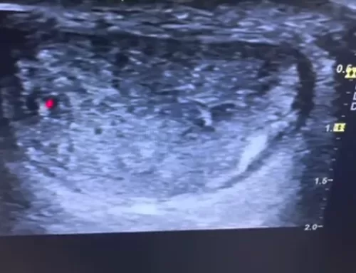 Achilles Tendinopathy, a True Tendinopathy