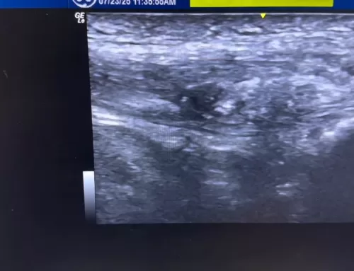 Understanding Infrapatellar Tendinopathy