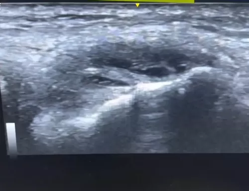 Understanding Lateral Epicondylar Tear Complex