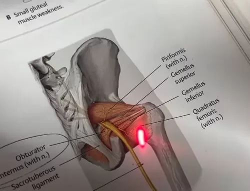 Understanding Lateral Hip Pain and Treatment Options